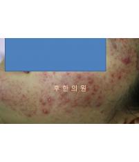 치료 전