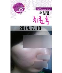 전후사진