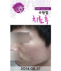 전후사진