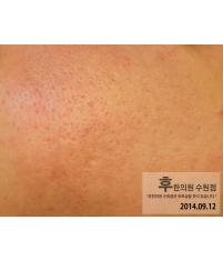 전후사진