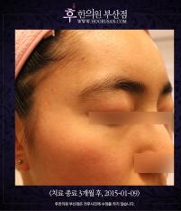 전후사진