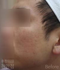 치료 전
