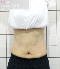전후사진