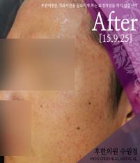 전후사진