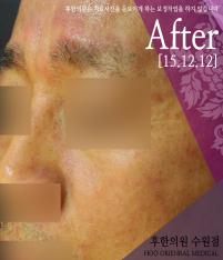 전후사진