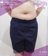 전후사진