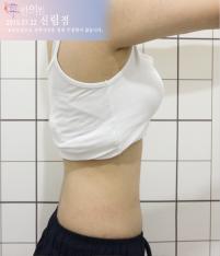 전후사진