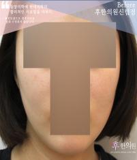 전후사진