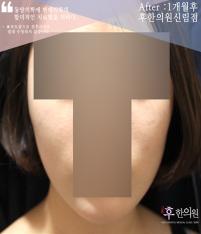 전후사진