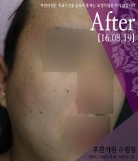 전후사진