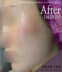 전후사진