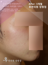 전후사진