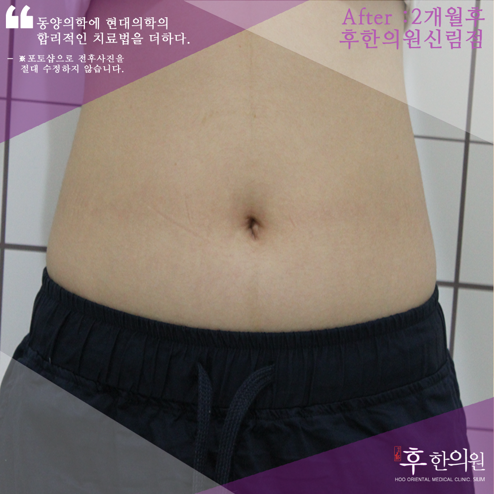 전후사진