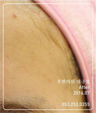 전후사진