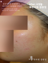 전후사진