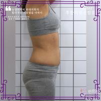 전후사진
