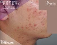 치료 전