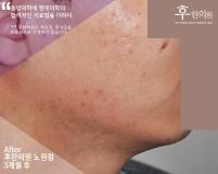 치료 후