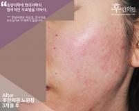 치료 후