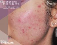 치료 전