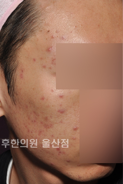 치료 전