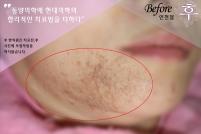 치료 전