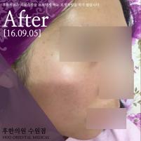 전후사진
