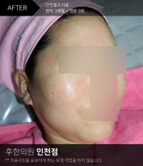 전후사진