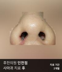 전후사진