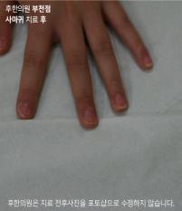전후사진