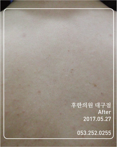 전후사진