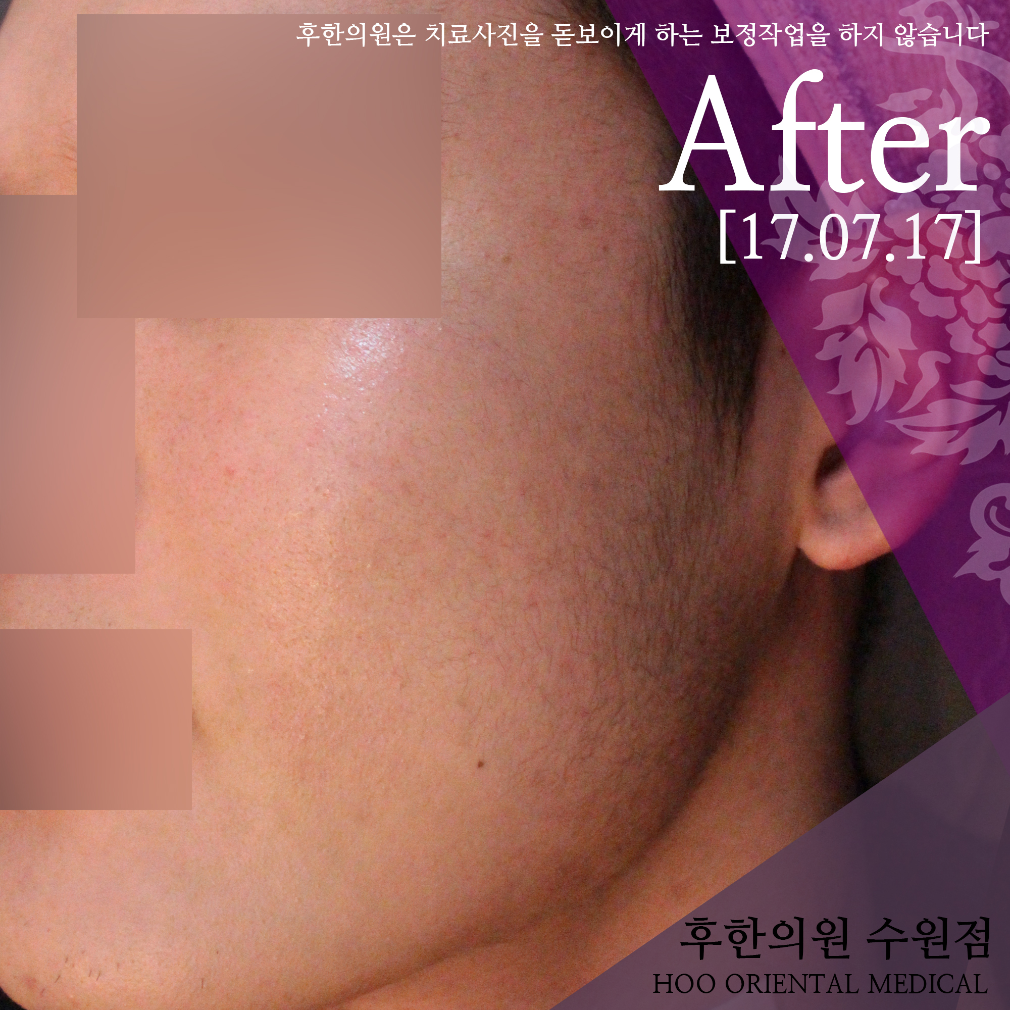 전후사진
