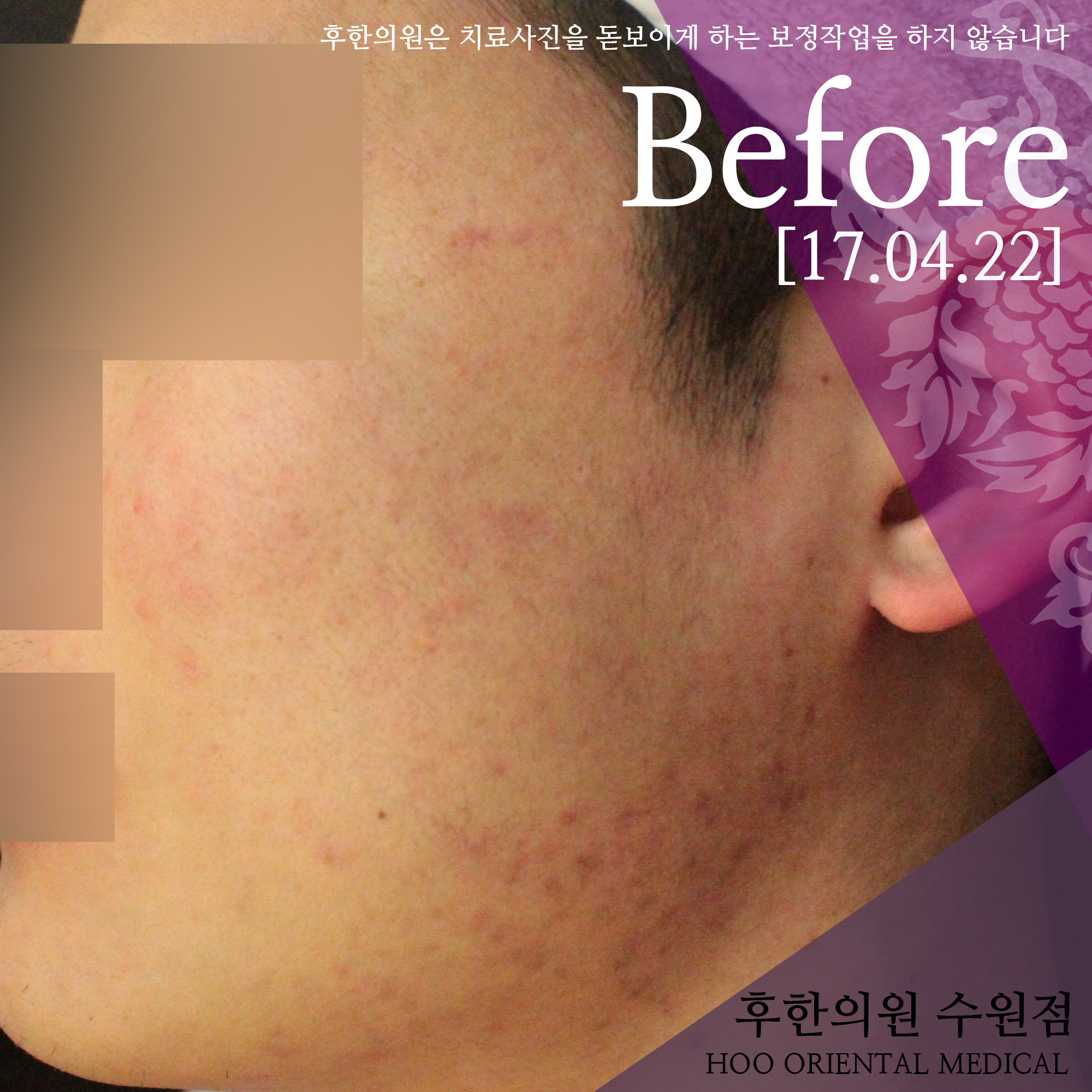 전후사진