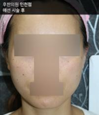 전후사진