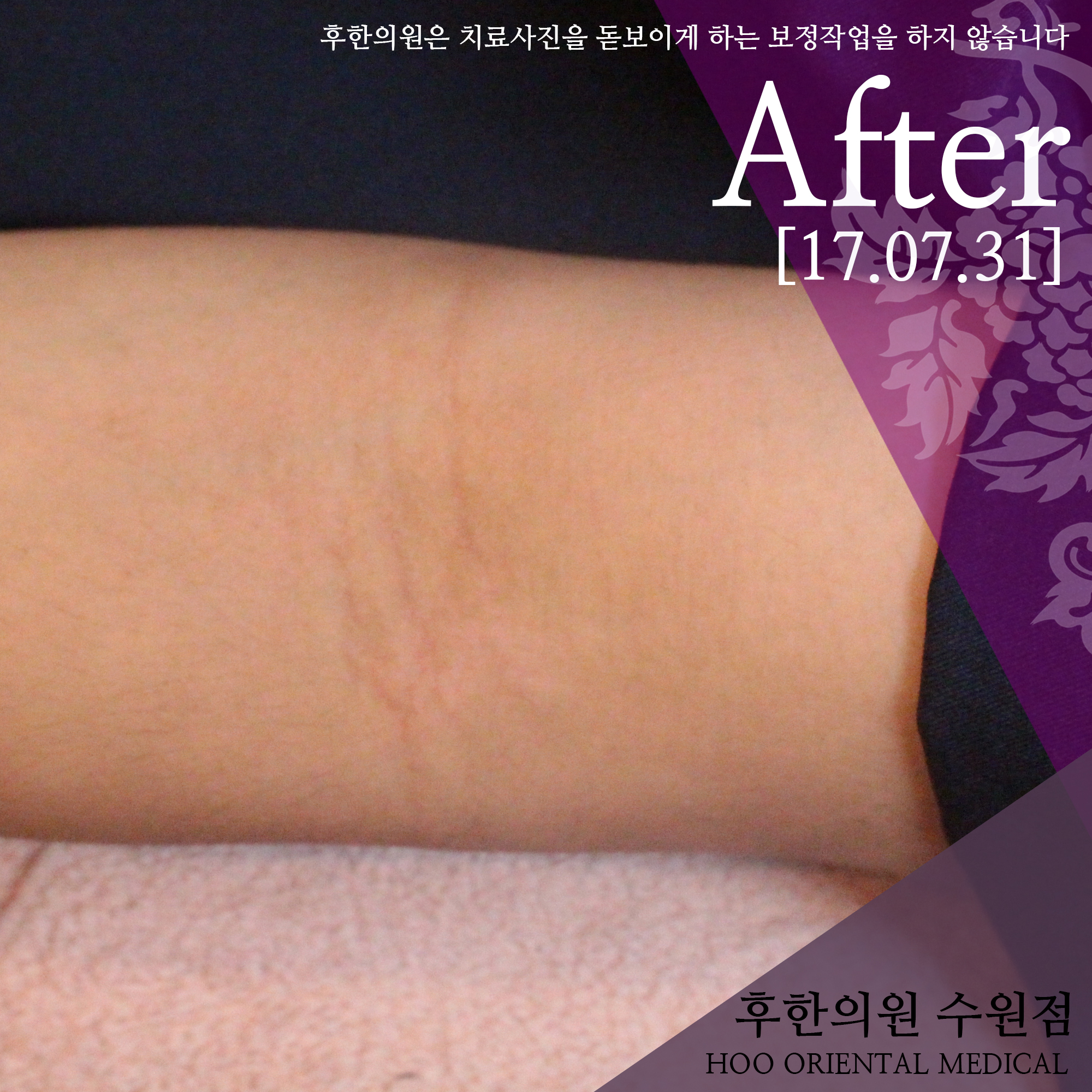 전후사진