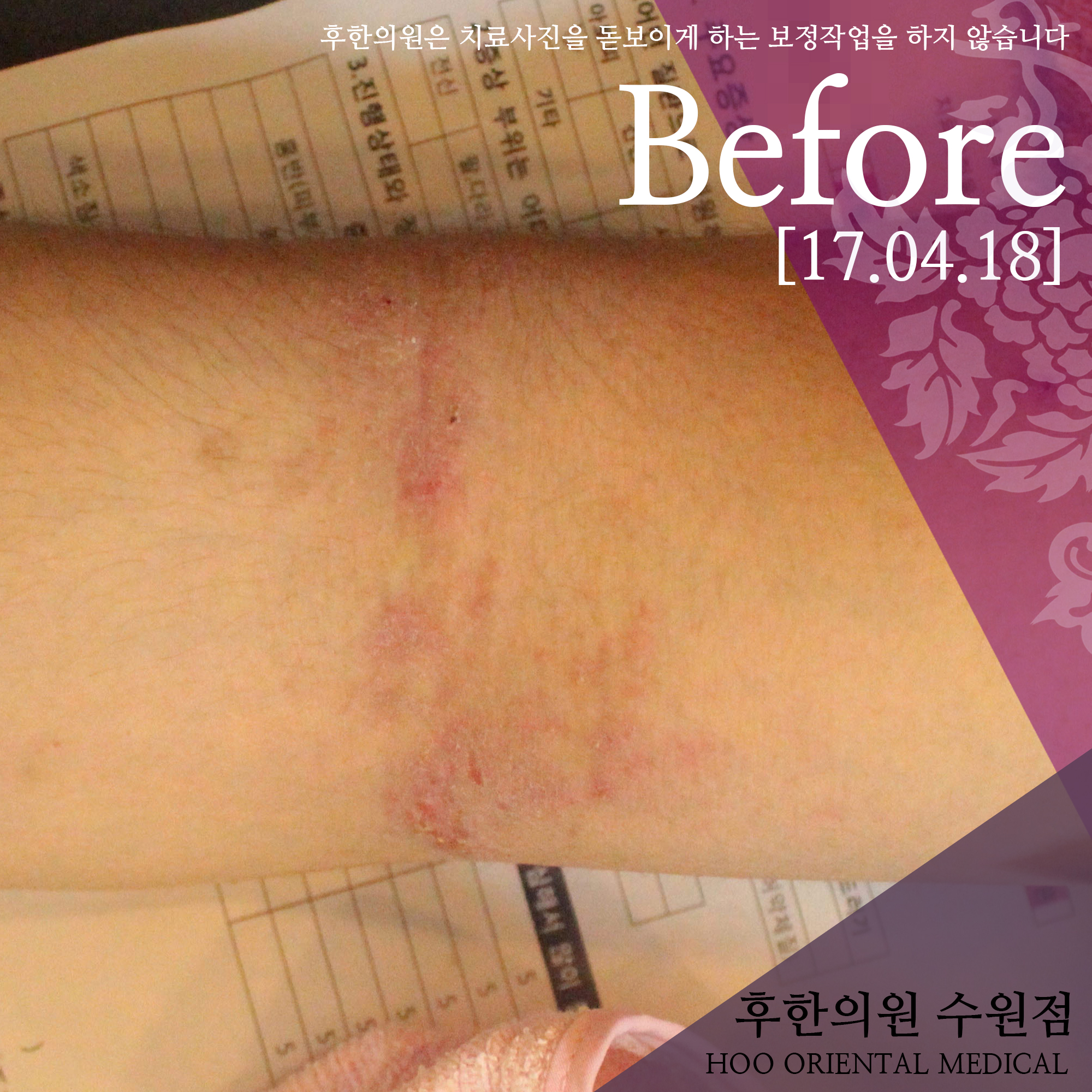 전후사진