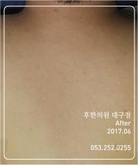 치료 후