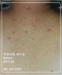 치료 전