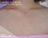 전후사진