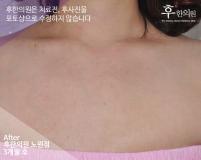 전후사진