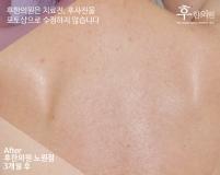 전후사진