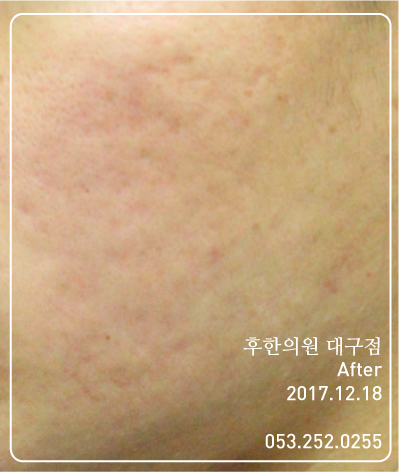 전후사진