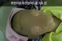 치료 전