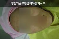 치료 후