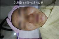 치료 전