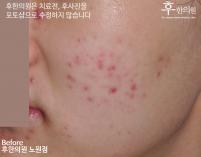 전후사진