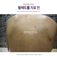 치료 전