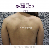 치료 후