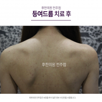 치료 후
