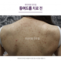 치료 전